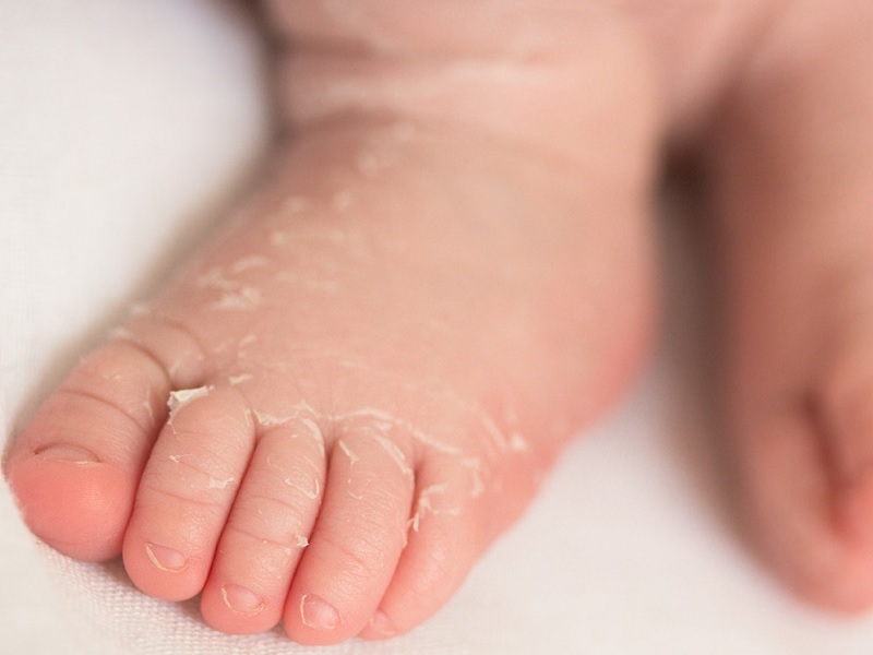 Da trẻ sơ sinh bị khô: Nguyên nhân và cách chăm sóc da khô | Omi Pharma