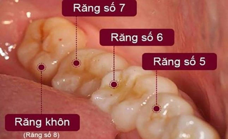 Cách để chăm sóc và bảo vệ răng số 7 khỏi bị sâu?
