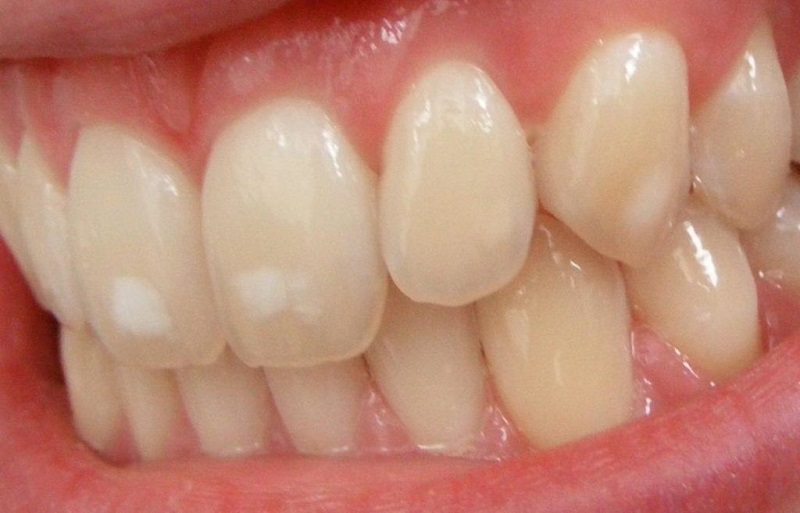 Dấu hiệu nhận biết răng bị sâu nhẹ là gì?
