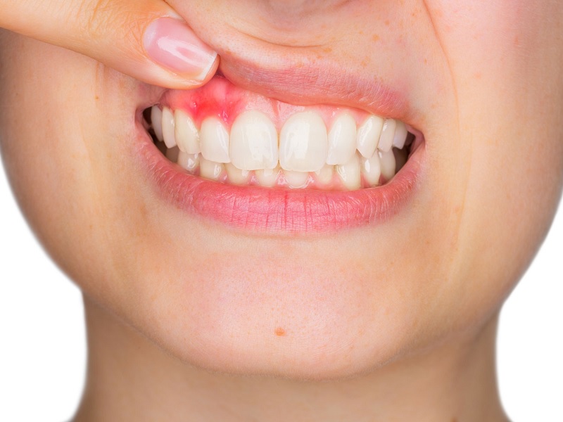 Hormone nào trong cơ thể mẹ bầu gây ra tình trạng chảy máu chân răng?
