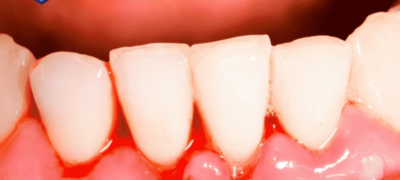 4 Cách điều trị chảy máu chân răng an toàn và hiệu quả nhất hiện nay  Công  Ty Cổ Phần Sao Thái Dương