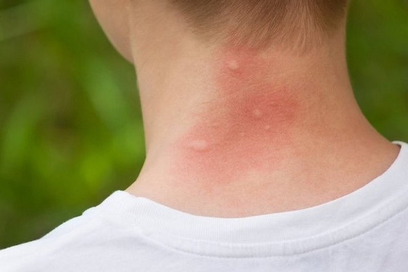 [GIẢI ĐÁP] Muỗi Anophen là muỗi gì? Gây bệnh gì và cách phòng tránh - 4
