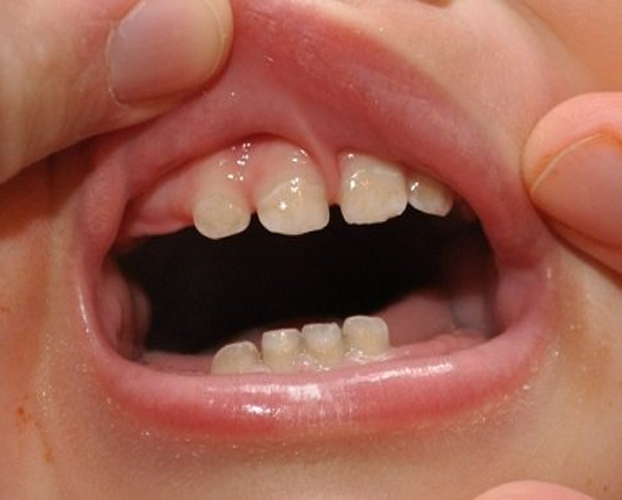 5 bệnh răng miệng trẻ em thường gặp 1