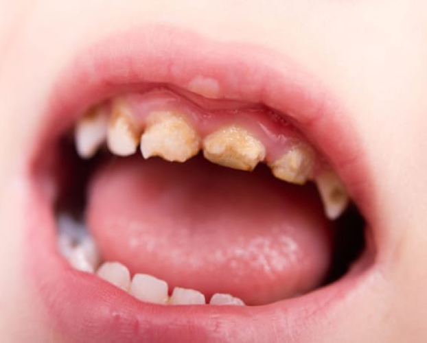 5 bệnh răng miệng trẻ em thường gặp 2