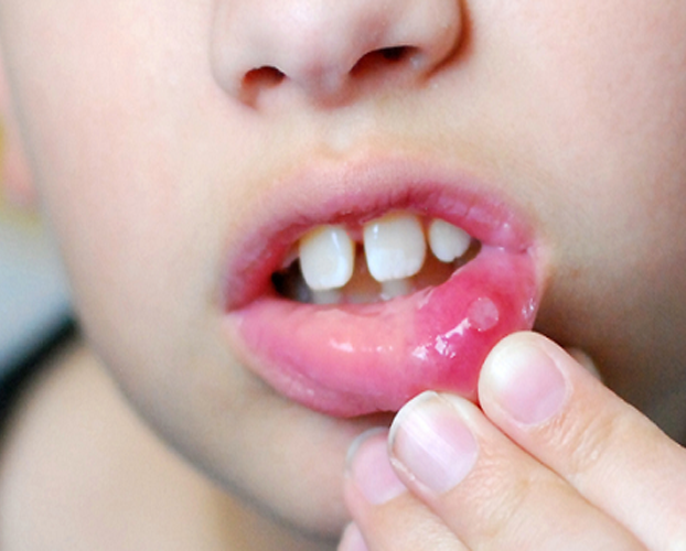 5 bệnh răng miệng trẻ em thường gặp 3