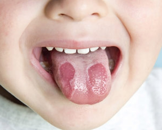 5 bệnh răng miệng trẻ em thường gặp 4