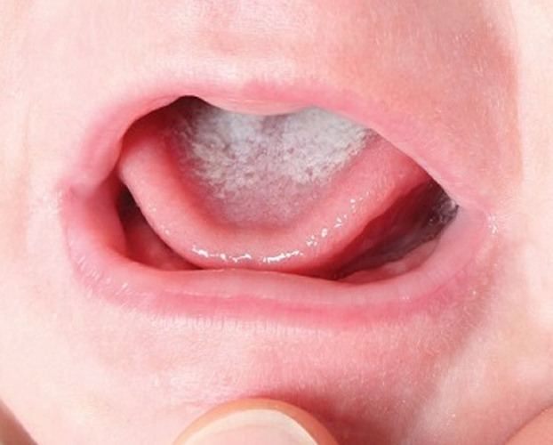 5 bệnh răng miệng trẻ em thường gặp 5