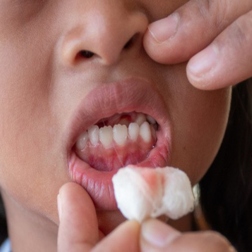 Tại sao trẻ bị sưng lợi chảy máu chân răng?
