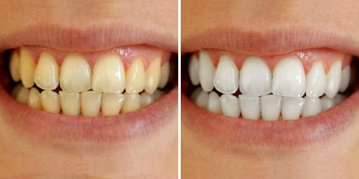 Bật mí cách lấy cao răng tại nhà đơn giản, hiệu quả 2