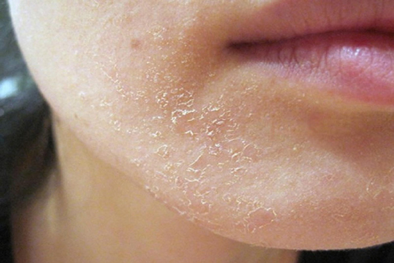 Nguyên nhân da mặt khô ngứa mẩn đỏ bong tróc và cách chữa trị 1
