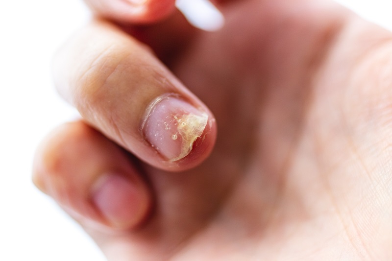 TƯ VẤN] Bệnh vảy nến móng tay là gì? Nguyên nhân, triệu chứng, cách điều  trị vảy nến móng tay | Omi Pharma
