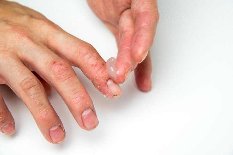 TƯ VẤN] Bệnh vảy nến móng tay là gì? Nguyên nhân, triệu chứng, cách điều  trị vảy nến móng tay | Omi Pharma
