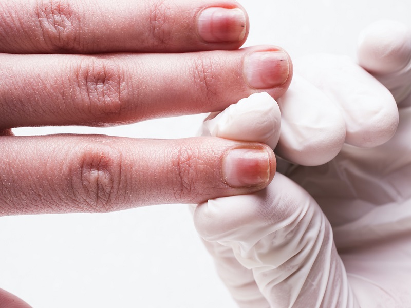 [TƯ VẤN] Bệnh vảy nến móng tay là gì? Nguyên nhân, triệu chứng, cách điều trị vảy nến móng tay-3