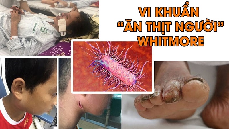 Tình hình phòng chống bệnh Whitmore hiện nay ở Việt Nam như thế nào?