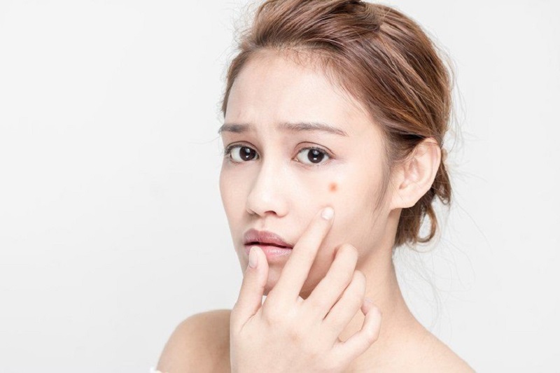[LÀM ĐẸP] 6 loại mặt nạ cho da mụn mùa đông dưỡng ẩm cực tốt